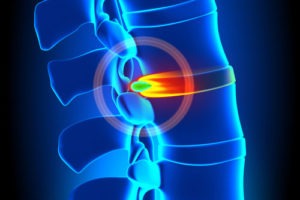 Herniated Slipped Disc Injury